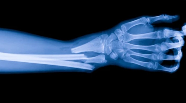Medicina: China inventa pegamento óseo casi instantáneo que evita insertar clavos o placas