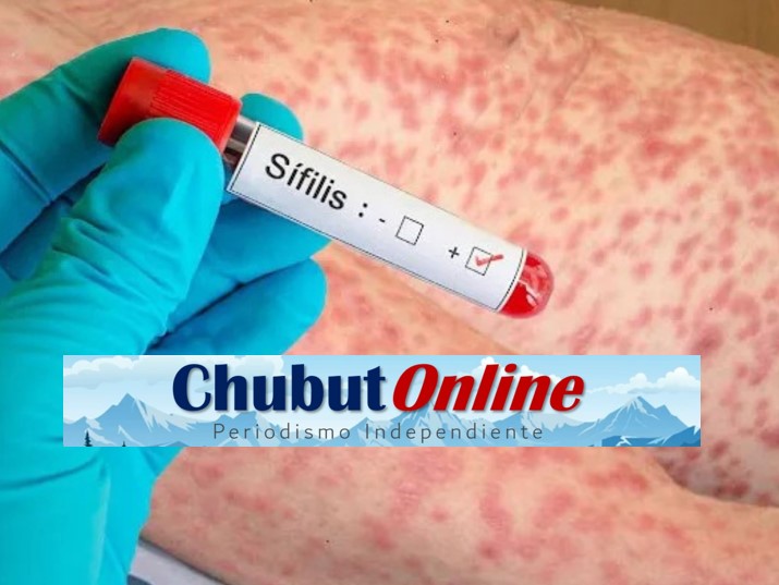 Sífilis en Argentina: importante aumento entre jóvenes