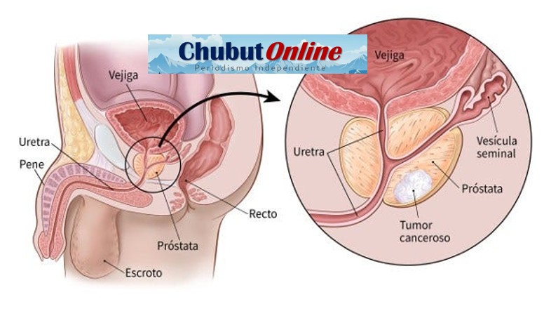 La Eyaculación Frecuente Reduciría Probabilidades de Cáncer de Próstata: 6 Claves Científicas